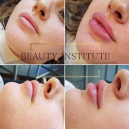 Aqua Beauty - Hyaluron Pen - Before & After